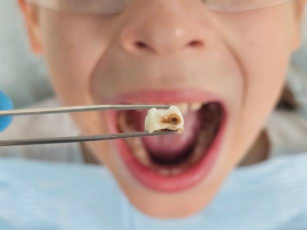 Best Emergency Treatment for Dental Infections or Abscesses in Foothill Farms, CA